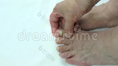 人`脚指甲真菌感染