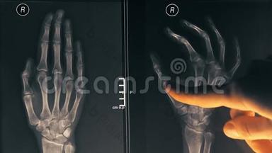 女医生向病人展示一只手的x光图像。 4K<strong>型</strong>特写镜头