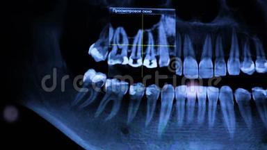 牙痛<strong>症状</strong>。 电脑上人下巴的X光片。 医生检查<strong>病人</strong>`下巴，治疗牙齿。