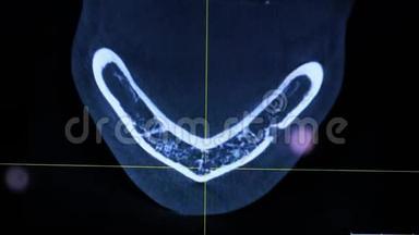 牙痛症状。 电脑上人下巴的X光片。 医生检查病人`下巴，治疗牙齿。