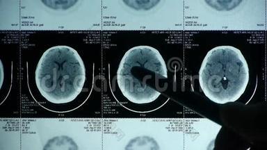 医生研究头部PET/ct扫描分析疾病，颅骨脑X线。