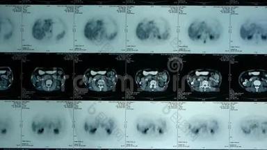 动人体器官pet-ct扫描，淋巴结X线，肿瘤转移..
