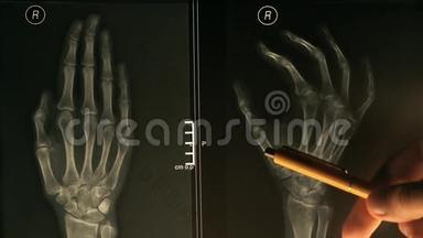 医生向病人解释手的x射<strong>线图</strong>像，颜色温暖。 4K特写视频