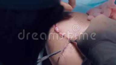外科医生的特写镜头是植入后双手缝合胸部