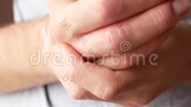 一个人用奶油涂抹他的手。 手的银屑病患者.. 皮肤上的皮炎..
