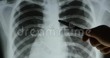 医生研究肋骨、肋笼关节X线片进行分析。医疗卫生医院。