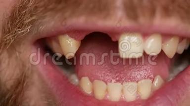 牙齿的特写。 一个男人在两颗牙齿上露出假牙。 <strong>没有</strong>足够的两颗牙齿，而不是塑料