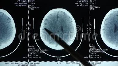 医生研究头部PET/ct扫描分析疾病，颅骨脑X线。