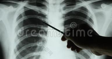 医生研究肋骨、肋笼关节X线片进行分析。医疗卫生医院。