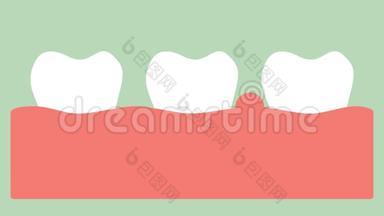 牙龈炎或牙龈病，牙周病前牙龈炎