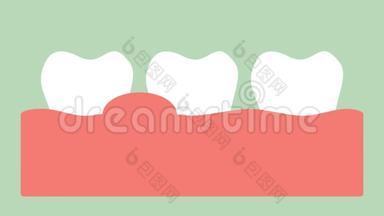 牙龈炎或牙龈病，牙周病前牙龈炎