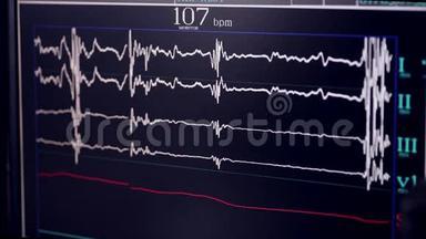 心脏造影。 在一家心脏病医院做心脏检查。