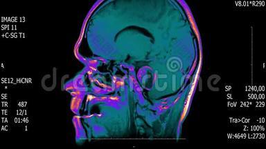 真实生命人脑核磁共振扫描与肿瘤<strong>医学研究</strong>新质量健康科学4k镜头股票动画