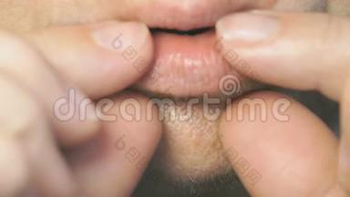 口腔炎在下唇上进入口腔。 特写