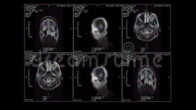 三维脑MRI，视频回路，α通道