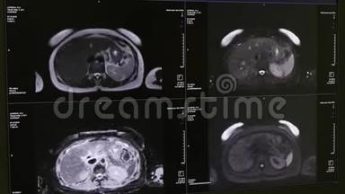 核磁共振扫描的脑部断层扫描。