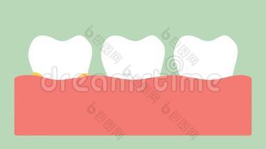 牙龈炎或牙龈疾病前的牙龈斑块