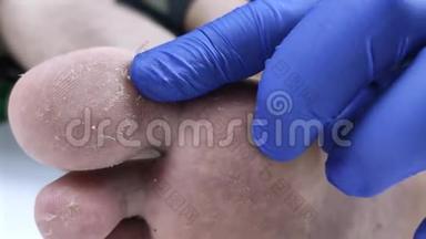 一位戴蓝色医用手套的医生检查病人腿上的真菌。 在医院检查。 一个脚怪的宏观视频