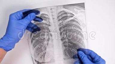 一名戴蓝色手套的医生的手检查，检查荧光成像，一名在流行病、肺炎和支气管炎期间的病人的x光