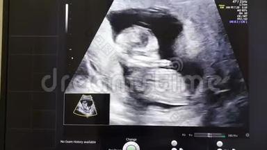 母亲子宫内婴儿`超声检查。
